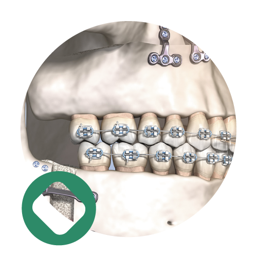 oroface-picto-orthognatique Chirurgie Orthognathique Institut Oroface